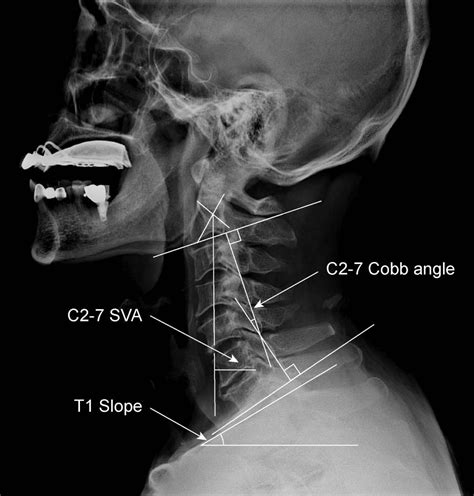 Relationship Between T1 Slope And Loss Of Lordosis After Laminoplasty