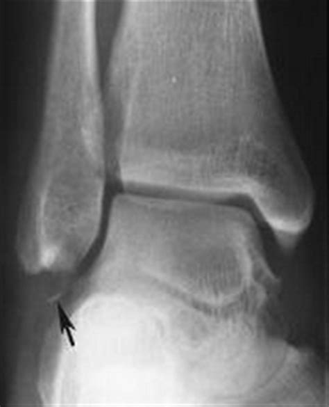 Lower Extremity Os Foot And Ankle Orthobullets