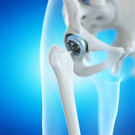 Anterior Hip Replacement Southern Utah Orthopaedic Surgery Center