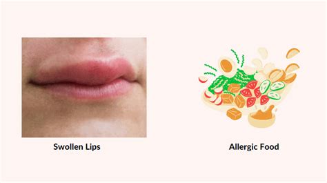 Swollen Lips Causes Treatment And More