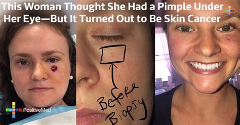 This Woman Thought She Had A Pimple Under Her Eye—but It Turned Out To
