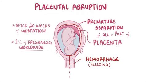 Abruptio Placentae Classification