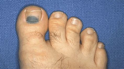 Bruised Toenail Falling Off How To Get It To Grow Back