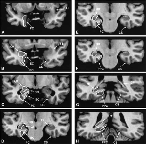 Medial Temporal Lobe Mri