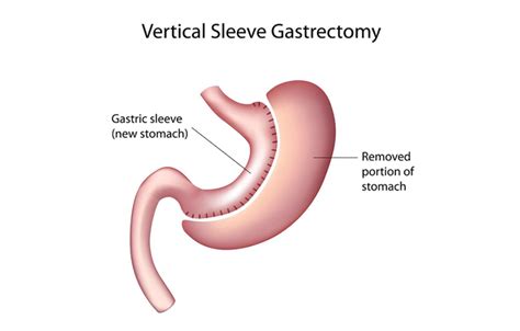 First Baptist Medical Center Gastric Sleeve Surgery Vertical Sleeve Gastrectomy First