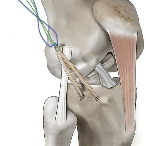 Right Knee A Anterior Cruciate Ligament Acl Tibial Guide Is Used