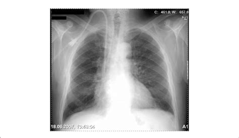Chest X Ray Of A Patient With A Tunnelled Right Internal Jugular Vein