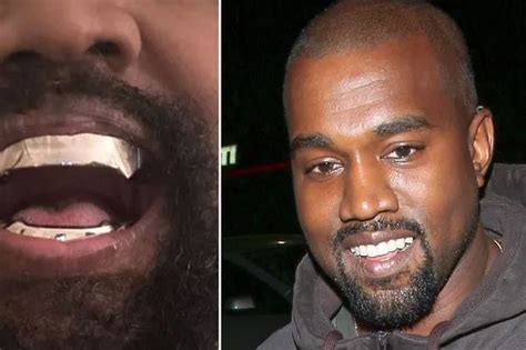 Kanye Wests New 850000 Experimental Titanium Teeth Are Fixed And