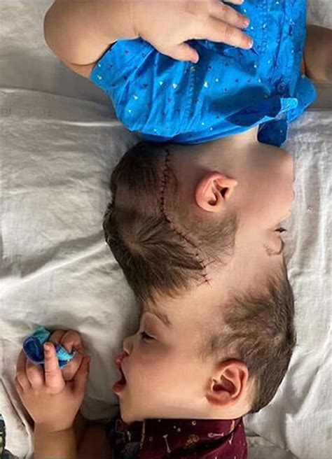 Twins Born With Fused Brains Separated After Historic Surgery