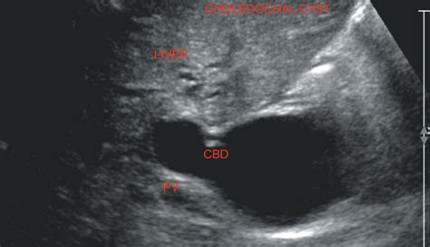 Biliary Tree Radiology Key