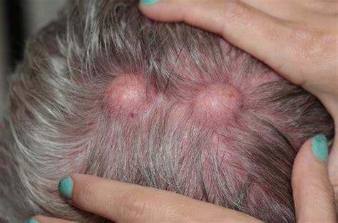 Pilar Cyst On Scalp Pictures Home Treatment And Removal