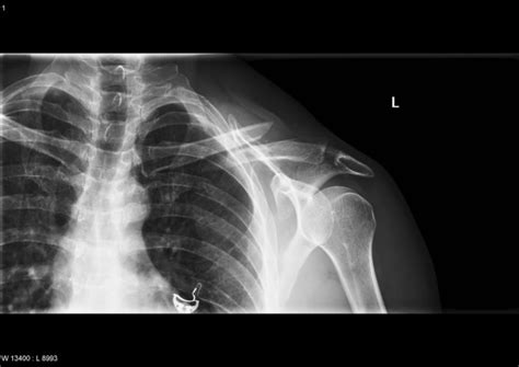 Clavicle Fracture Radrounds Radiology Network