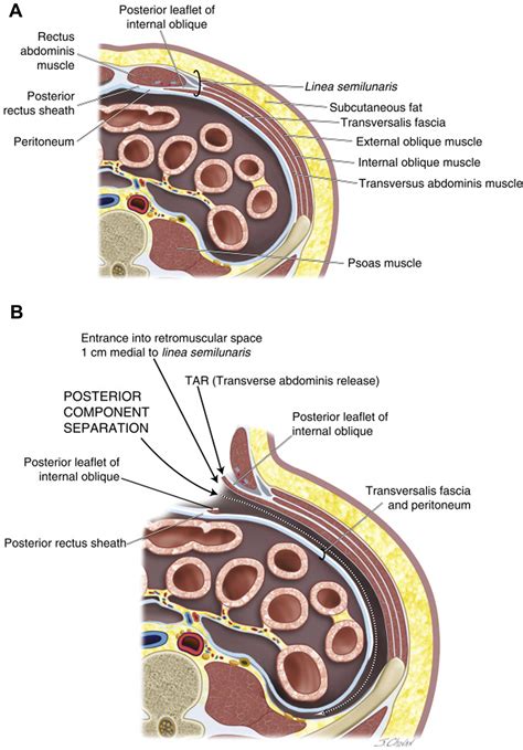 Surgical Management Of Parastomal Hernias Surgical Clinics
