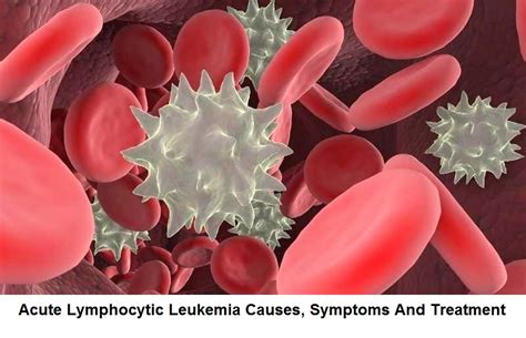 Acute Lymphocytic Leukemia Causes Symptoms And Treatment Health And