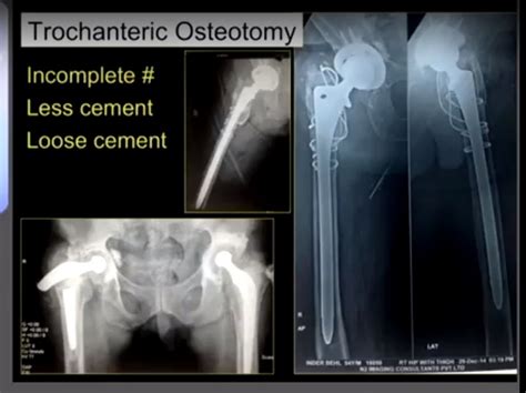 Bone Cement Removal During Revision Hip Arthroplasty
