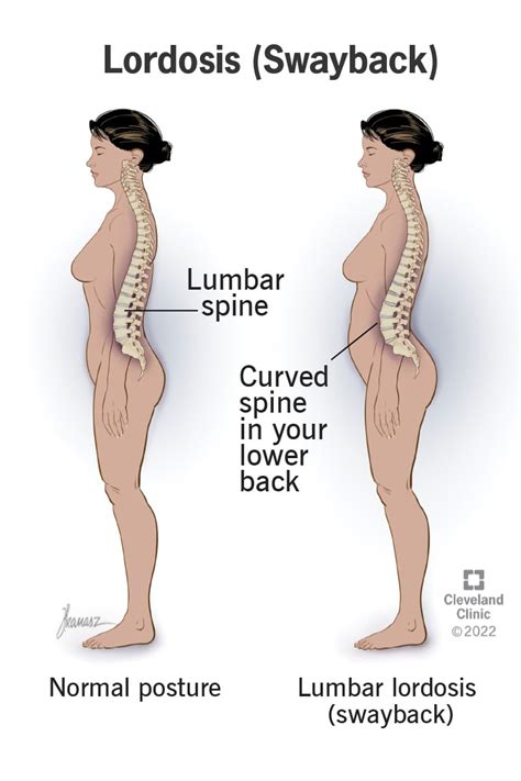 Lordosis Swayback Types Causes And Symptoms