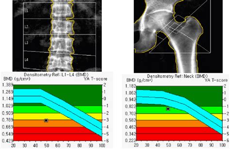 Bone Mineral Density Spine Ap T Score 31 Osteoporosis In The