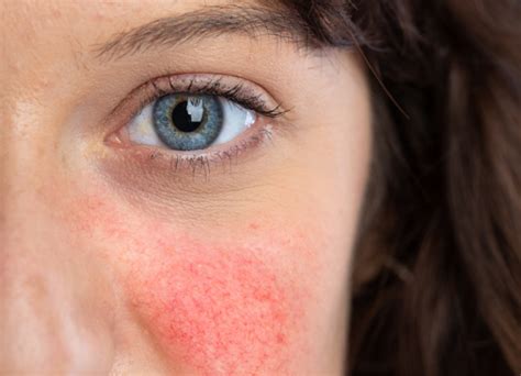 Do You Have These 9 Symptoms Of Rosacea Guides