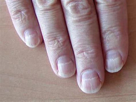 See a doctor for evaluation if you notice ridges forming on your nails. Colour Of Your Nails Say A Lot About Your Health - Boldsky.com
