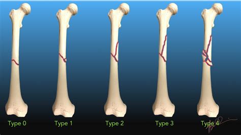 Types Femoral Shuft Fractures Realistic Drawing The Best Porn Website