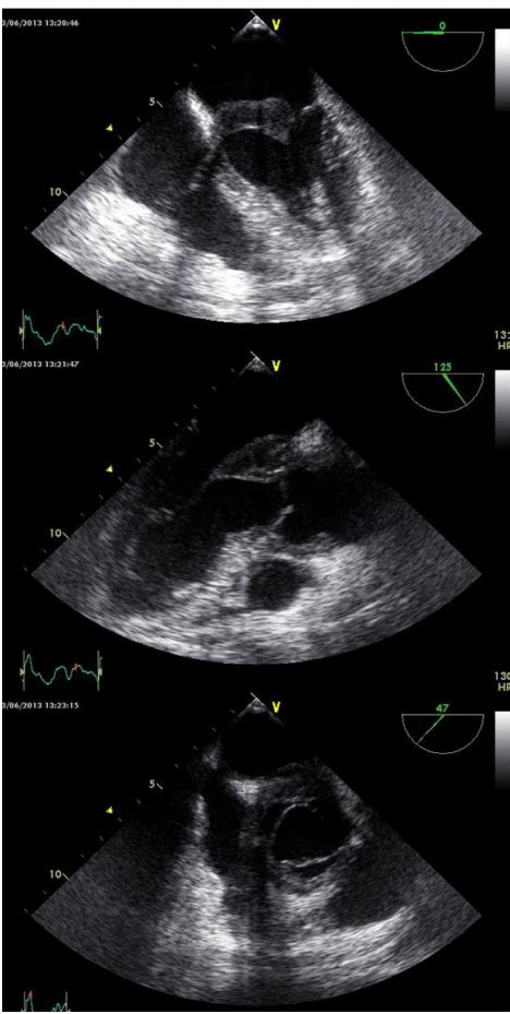 Anterior Mitral Valve Thickening In Transesophageal Echocardiography