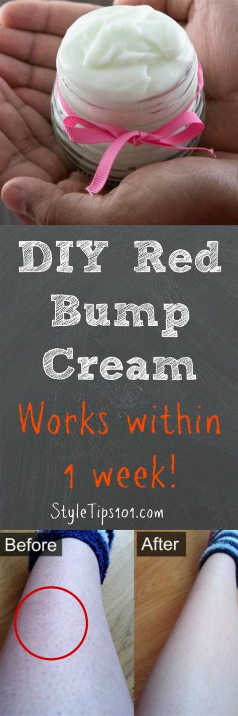 Diy Red Bump Cream For Ingrown Hair And Skin Blemishes