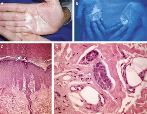 Aquagenic Keratoderma Medizzy