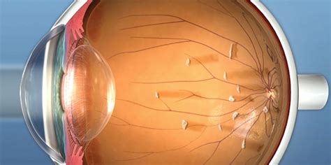 Floaters In The Eye Treatment Symptoms And Causes