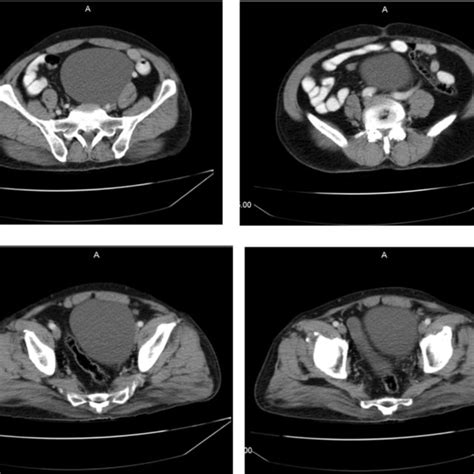 A Contrast Enhanced Ct Scan Of The Abdomen And Pelvic A Well Defined