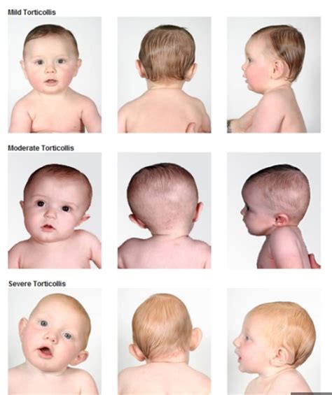 Should I Worry My Babys Head Tilt Is Torticollis Play On Pediatric