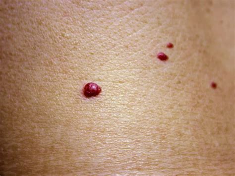 Cherry Angioma Symptoms Causes And Treatment 41 Off