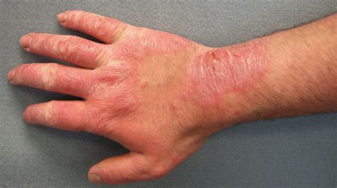 Scaling Skin Pictures Causes Diagnosis And Treatment
