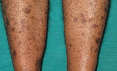 Brown Spots On Legs Lower Legs Get Rid Of Little Light Brown Dots On Ankles Feet And Legs