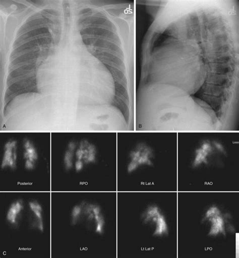 Chronic Pulmonary Embolism Radiology Key