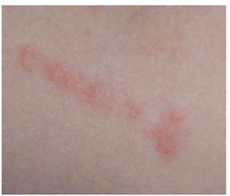Skin Rashes That Itch Lines Webcamdiki Vrogue Co