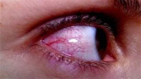 What To Do About Red Veins On The Whites Of The Eyes Youmemindbody
