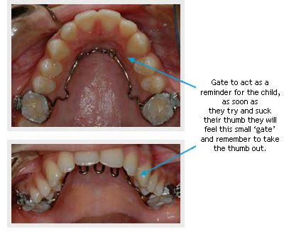 Stop A Thumb Sucking Habit West London Orthodontist Blog By Dr Kyi