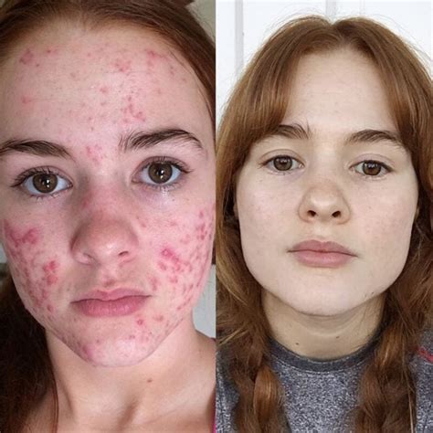 Esta chica mostró el increíble antes y después de tener acné