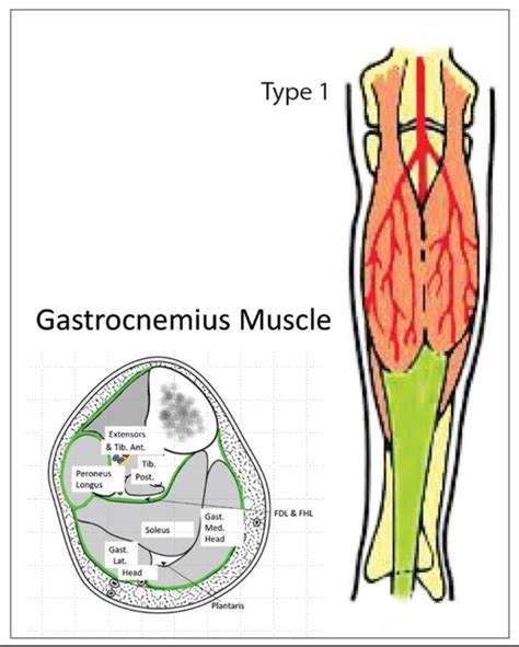 The Medial Gastrocnemius Flap The Pmfa Journal