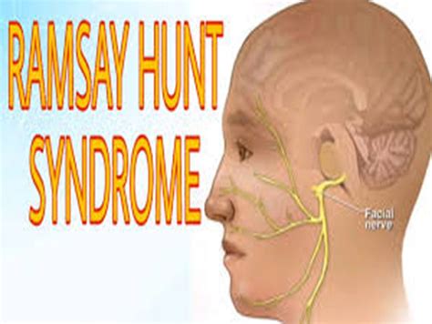 Ramsay Hunt Syndrome Demystified Causes Symptoms And Treatment