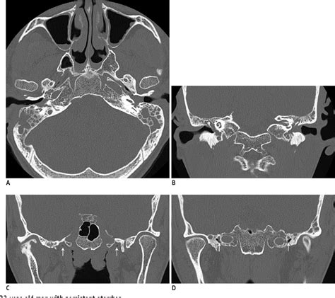 Figure 2 From Eosinophilic Otitis Media Ct And Mri Findings And