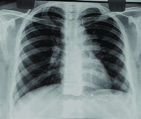 Chest X Ray Showing Bilateral Hilar Lymphadenopathy Download
