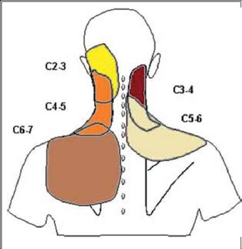 Cervical Radiculopathy Patterns