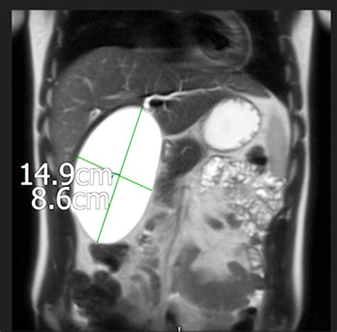 A Rare Case Of Gastric Outlet Obstruction Secondary To Hydrops Of