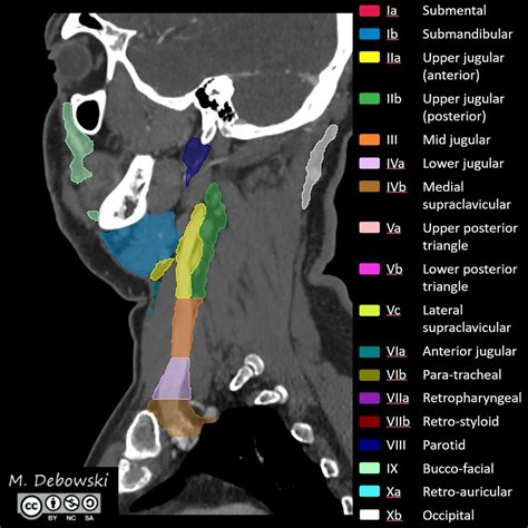 Lymph Node Levels Of The Head And Neck Annotated Ct Image My Xxx Hot Girl
