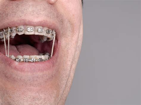 Orthodontics Invisalign Ceramic Fast Braces Metal