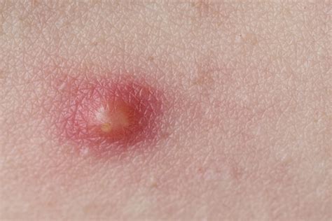 Everything You Need To Know About Pustules Be Beautiful India