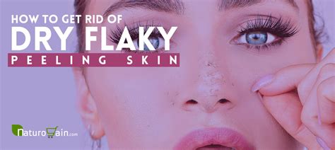 How To Get Rid Of Dry Flaky Peeling Skin On The Face Fast