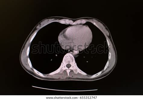 Transverse View Axial Plain Ct Chest Stock Photo 655312747 Shutterstock