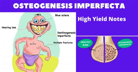 Osteogenesis Imperfecta Medinaz Highyield Notes Medinaz Blog